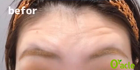 おでこのシワの治療前の写真