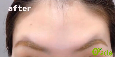 おでこのシワの治療後の写真