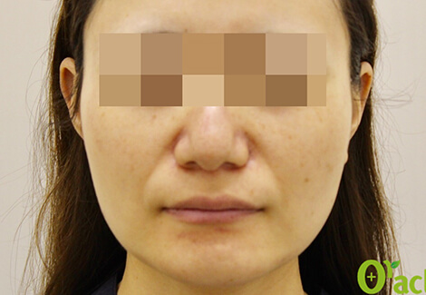 張ったエラの治療前の写真