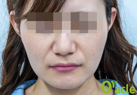 張ったエラの治療後の写真