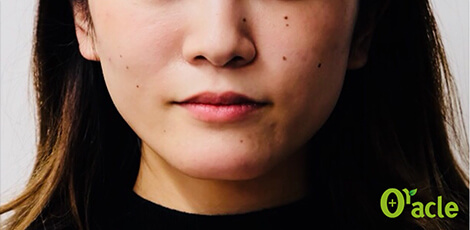 張ったエラの治療前の写真