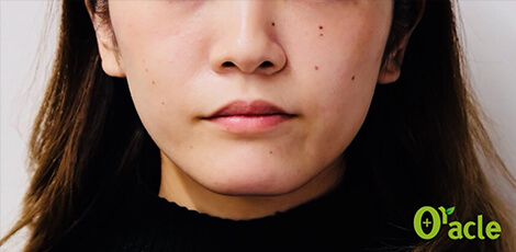 張ったエラの治療後の写真