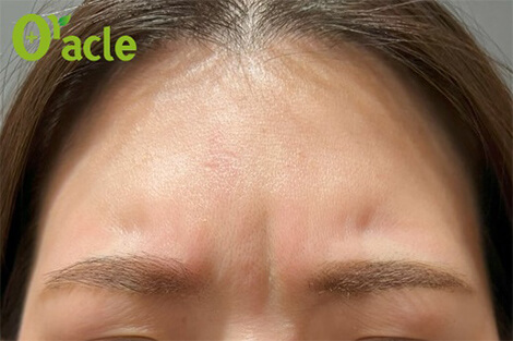 眉間のシワの治療前の写真