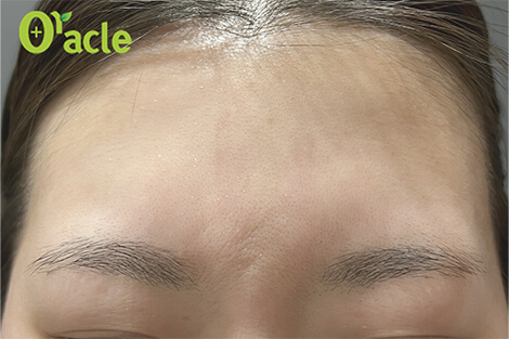 眉間のシワの治療後の写真