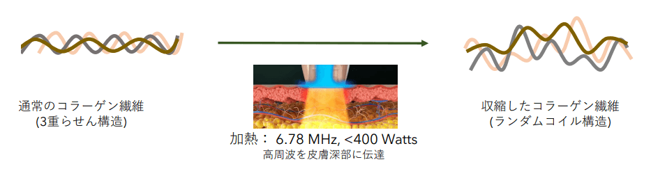 通常のコラーゲン遷移を加熱・高周波を皮膚深部に伝達することで収縮したコラーゲン繊維となります。