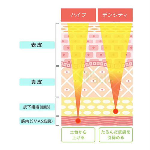 デンシティとハイフの違いについて、ハイフは筋膜、高周波は脂肪層に作用する