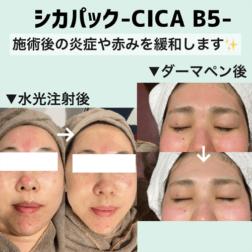 ダーマペン4 毛穴やニキビ跡 クレーター肌 に 公式 オラクル美容皮膚科 東京新宿院 渋谷院 名古屋院 大阪梅田院 福岡天神院 ダーマペン4 毛穴やニキビ跡 クレーター肌 に 公式 オラクル美容皮膚科 東京新宿院 渋谷院 名古屋院 大阪梅田院 福岡天神院