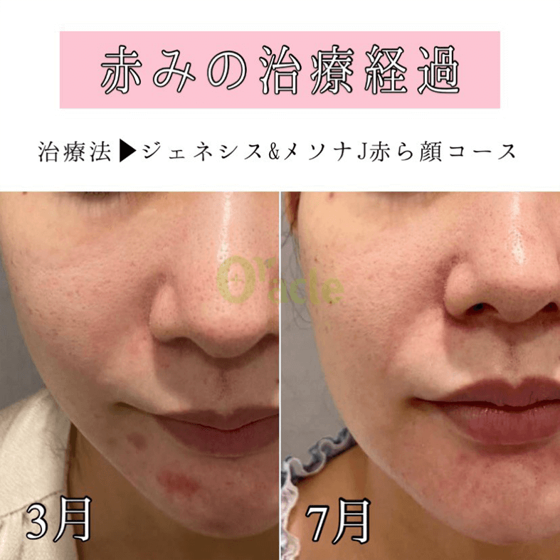 ジェネシスレーザー 肌の代謝アップ 公式 オラクル美容皮膚科 東京新宿院 渋谷院 名古屋院 大阪梅田院 福岡天神院 ジェネシスレーザー 肌の代謝アップ 公式 オラクル美容皮膚科 東京新宿院 渋谷院 名古屋院 大阪梅田院 福岡天神院