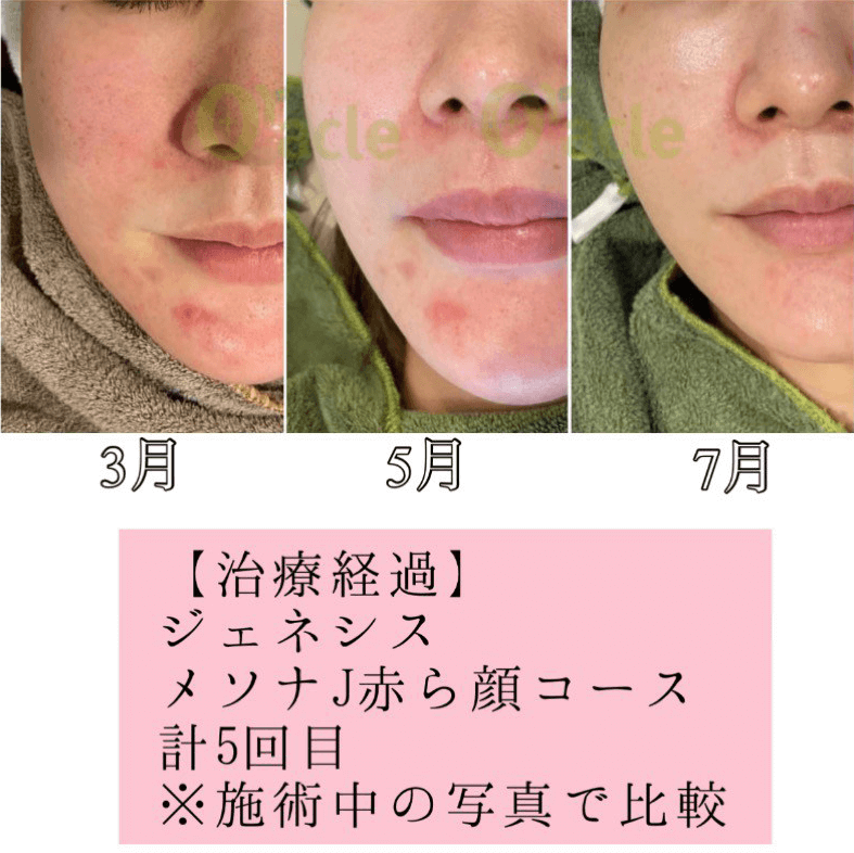 ジェネシスレーザー 肌の代謝アップ 公式 オラクル美容皮膚科 東京新宿院 渋谷院 名古屋院 大阪梅田院 福岡天神院 ジェネシスレーザー 肌の代謝アップ 公式 オラクル美容皮膚科 東京新宿院 渋谷院 名古屋院 大阪梅田院 福岡天神院
