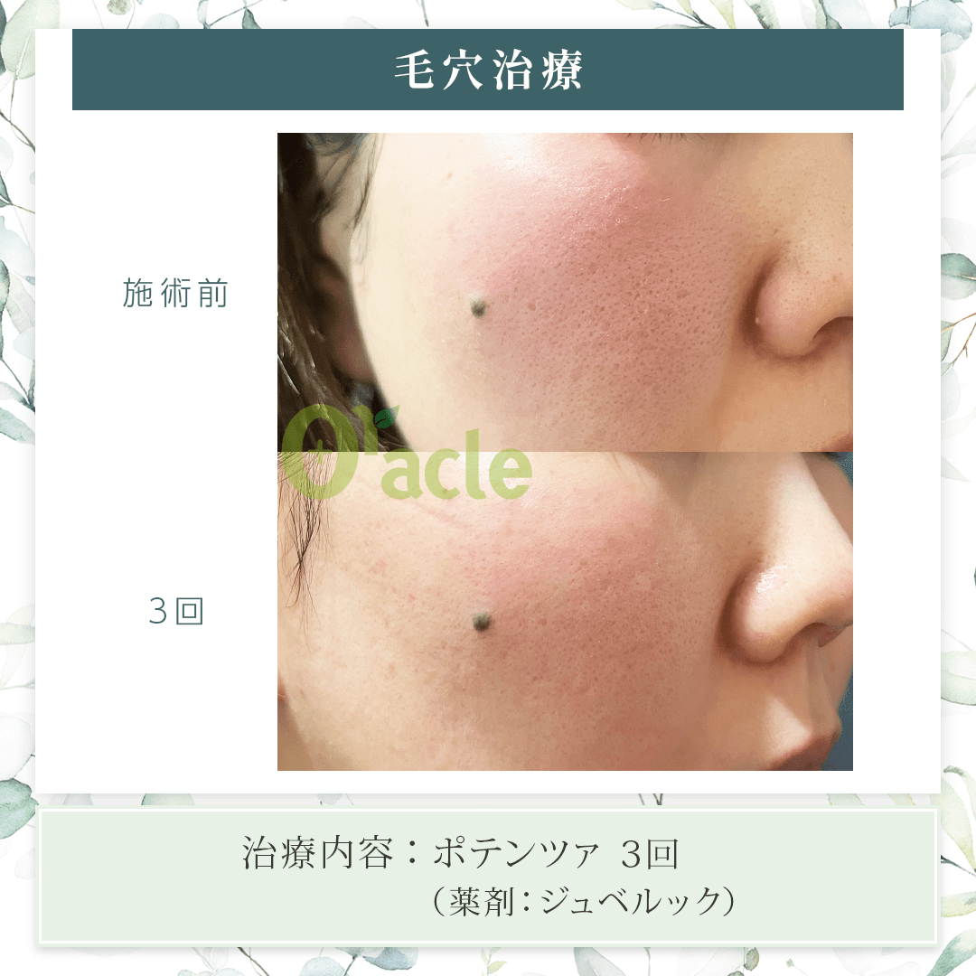 ジュベルックの治療前の写真です。