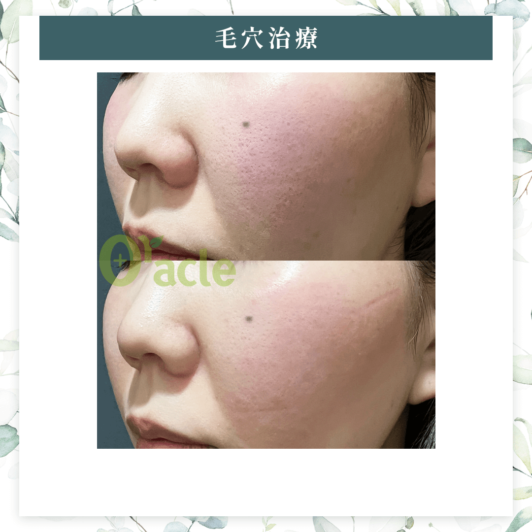 ジュベルックの治療後の写真です。