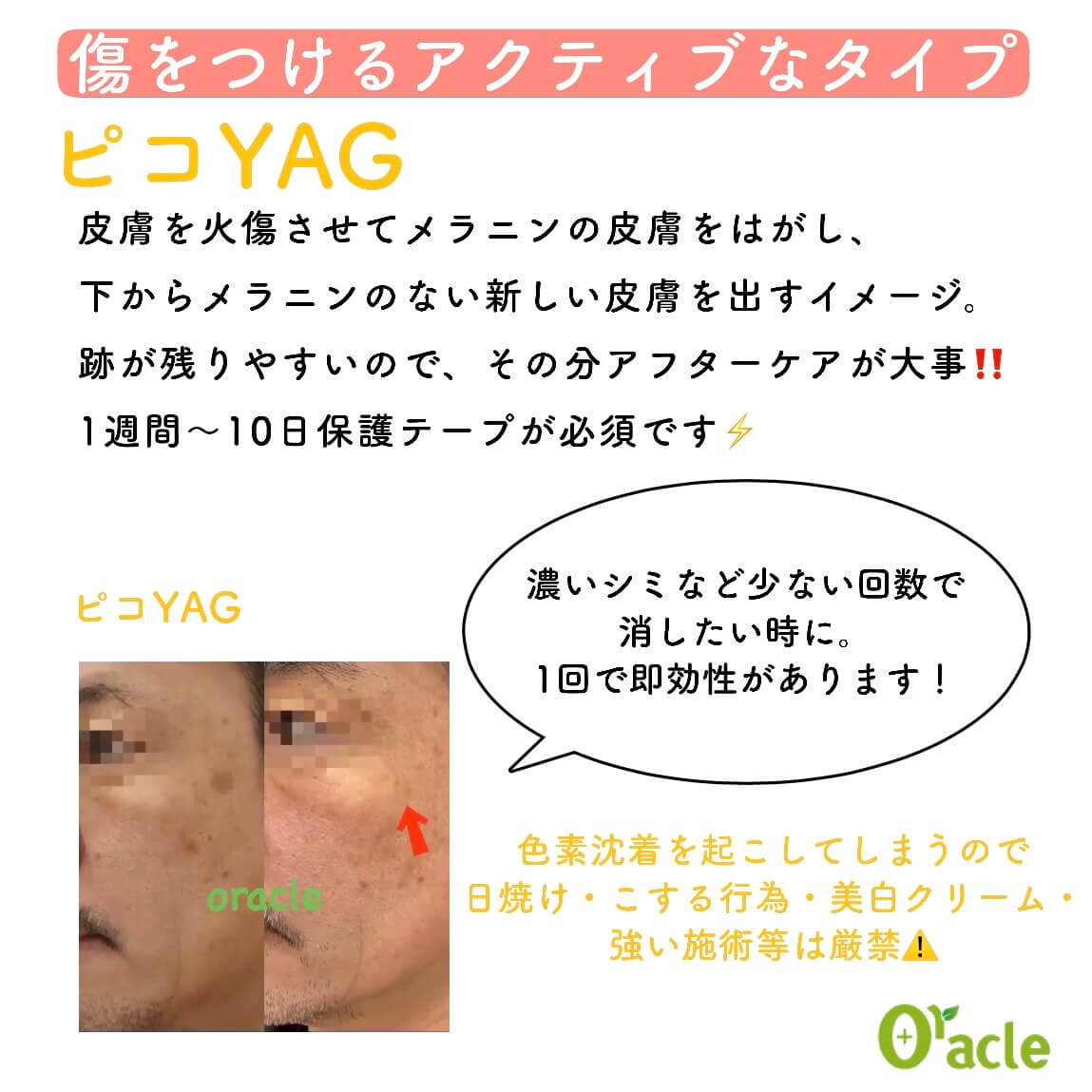 傷をつけるアクティブなタイプ ピコYAG