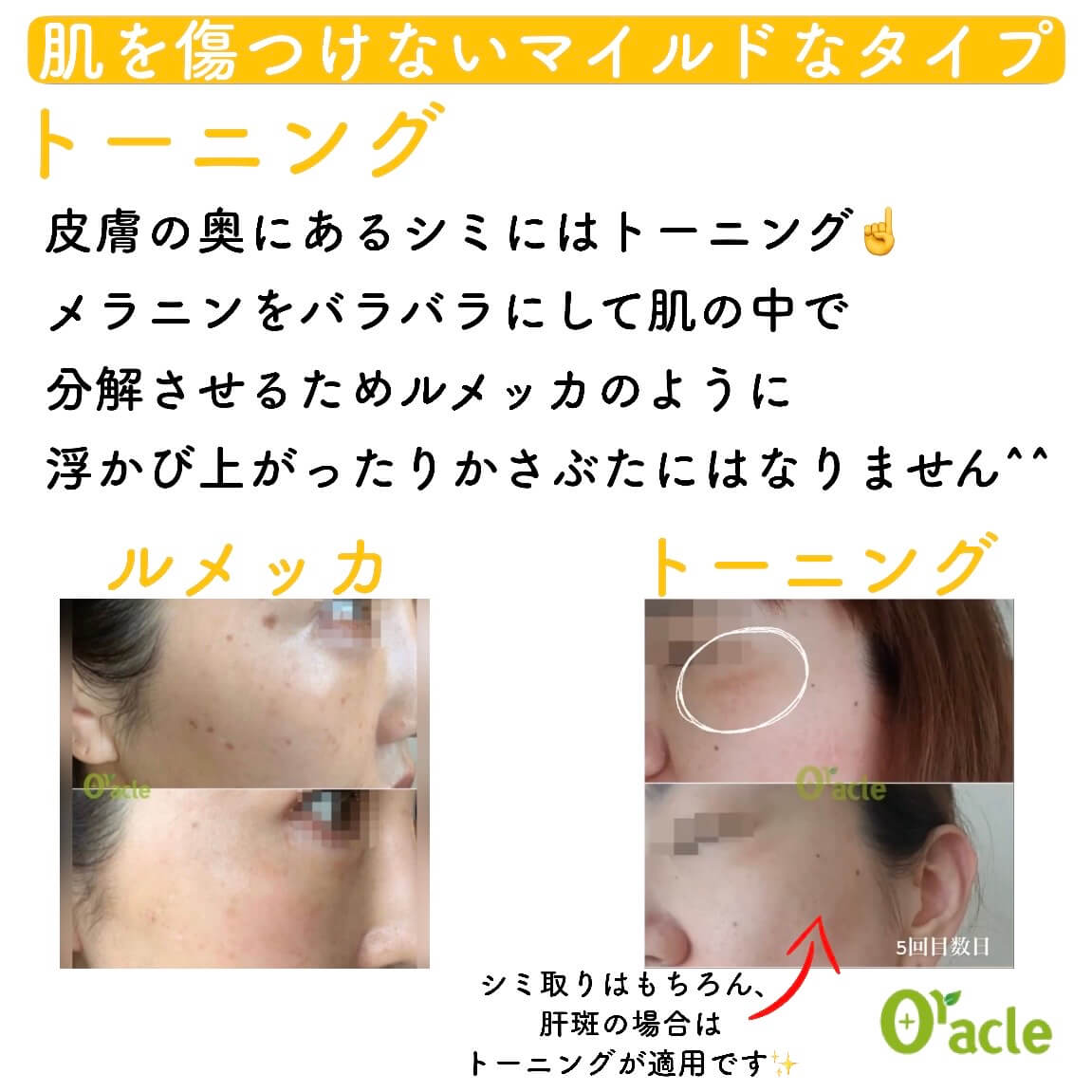 肌を傷つけないマイルドなタイプ トーニング