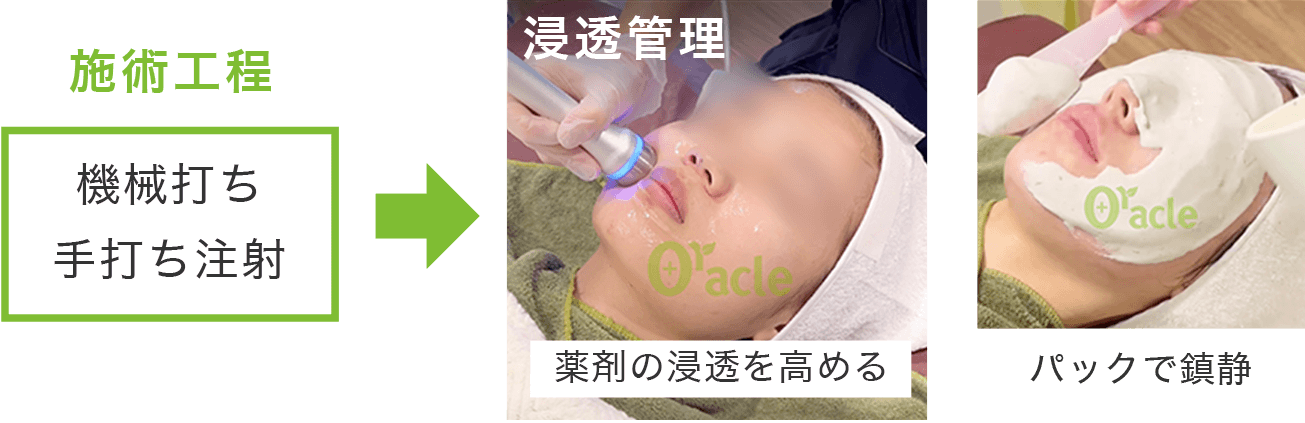 施術工程(機械打ち・手打ち注射)⇒LDM浸透管理で薬剤の浸透を高め・パックで鎮静します