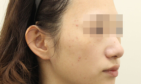 クリスタル水光注射治療前の写真です。