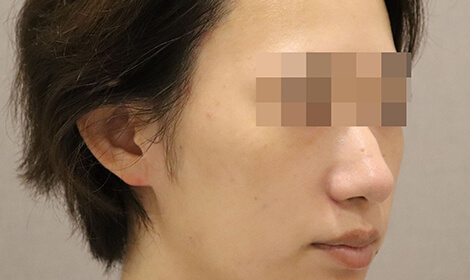 クリスタル水光注射治療後の写真です。