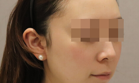 美白水光注射治療前の写真です。