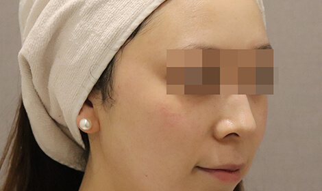 美白水光注射治療後の写真です。