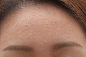 初期ニキビ（白ニキビ）