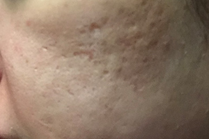 ニキビ跡（凹み、クレーター）