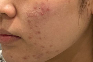 ニキビ跡（赤み）