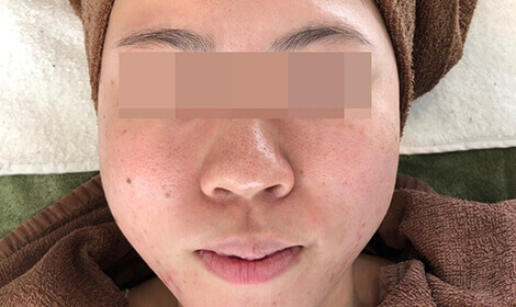 美肌 美白 くすみ クマの治療 公式 オラクル美容皮膚科 東京新宿院 渋谷院 名古屋院 大阪梅田院 福岡天神院 美肌 美白 くすみ クマの治療 公式 オラクル美容皮膚科 東京新宿院 渋谷院 名古屋院 大阪梅田院 福岡天神院