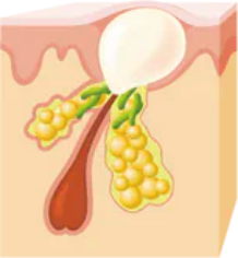 白ニキビ(閉鎖面皰)