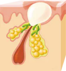 赤ニキビ(赤色丘疹)
