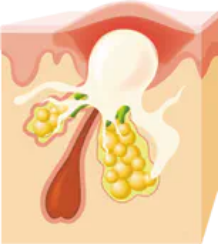 黄ニキビ(膿疱)