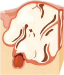 紫ニキビ(嚢腫)