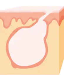 紫ニキビ(嚢腫)