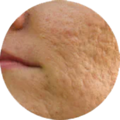 紫ニキビ(嚢腫)