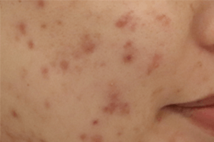 赤みのあるニキビ跡