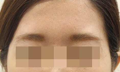 たるみ しわの治療 気になる目尻 目の下 ほうれい線に 公式 オラクル美容皮膚科 東京新宿院 渋谷院 名古屋院 大阪梅田院 福岡天神院 たるみ しわの治療 気になる目尻 目の下 ほうれい線に 公式 オラクル美容皮膚科 東京新宿院 渋谷院 名古屋院 大阪梅田院 福岡天神院