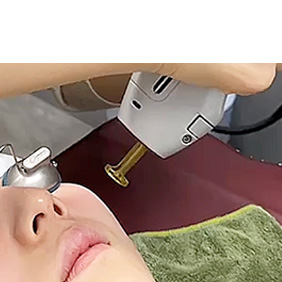 ジェネシス（ロングパルスヤグレーザー）