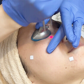 トライビーム（PTPトーニング／GEN）