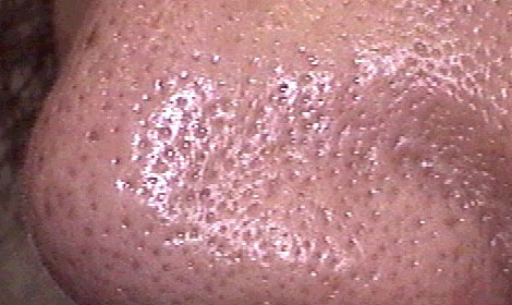 ニキビ ニキビ跡 毛穴の症例 公式 オラクル美容皮膚科 東京新宿院 渋谷院 名古屋院 大阪梅田院 福岡天神院