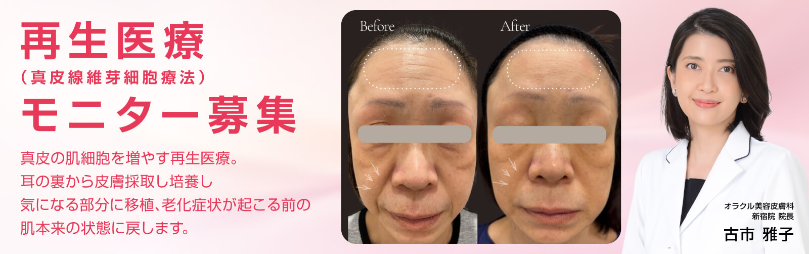 再生医療（真皮線維芽細胞療法） モニター募集