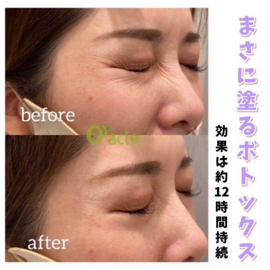 New 塗るボトックス リボックス7 公式 オラクル美容皮膚科 東京新宿院 名古屋院 大阪梅田院