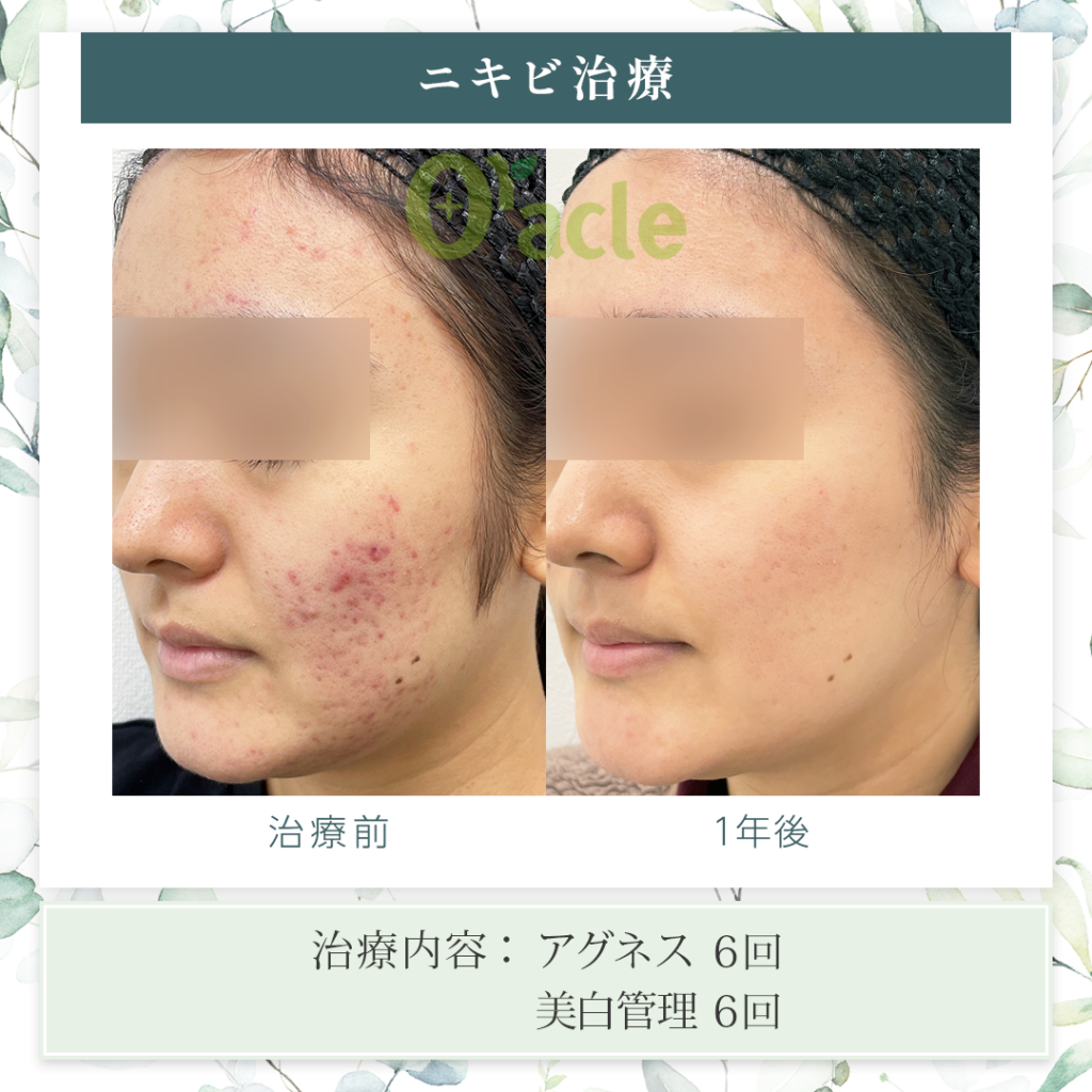 ニキビ治療の治療前・治療1年後の画像です。※【治療内容】アグネス・美白管理