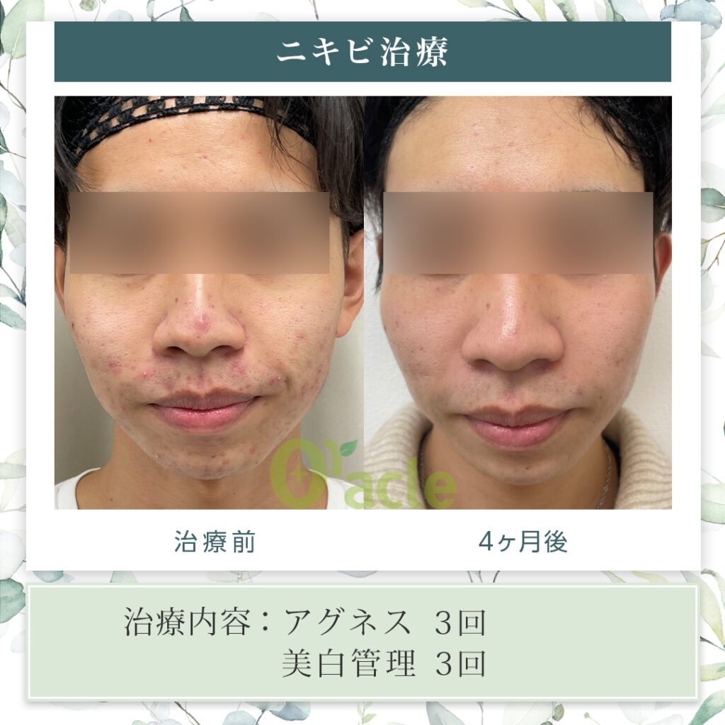 ニキビ治療の治療前・治療4カ月後の画像です。※【治療内容】アグネス・美白管理