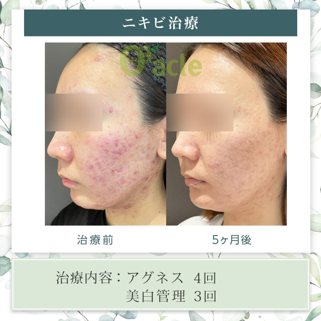 ニキビ治療の治療前・治療5カ月後の画像です。※【治療内容】アグネス・美白管理
