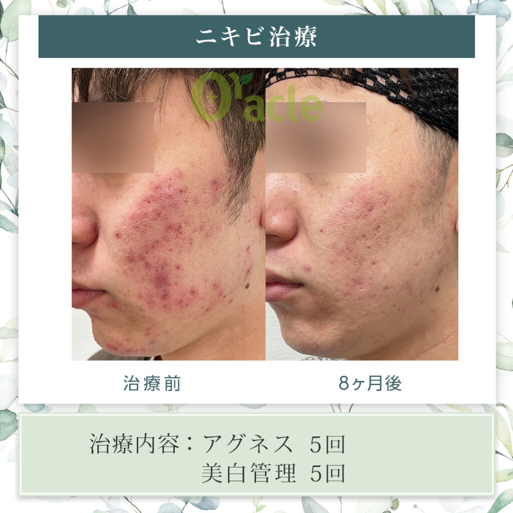 ニキビ治療の治療前・治療8カ月後の画像です。※【治療内容】アグネス・美白管理